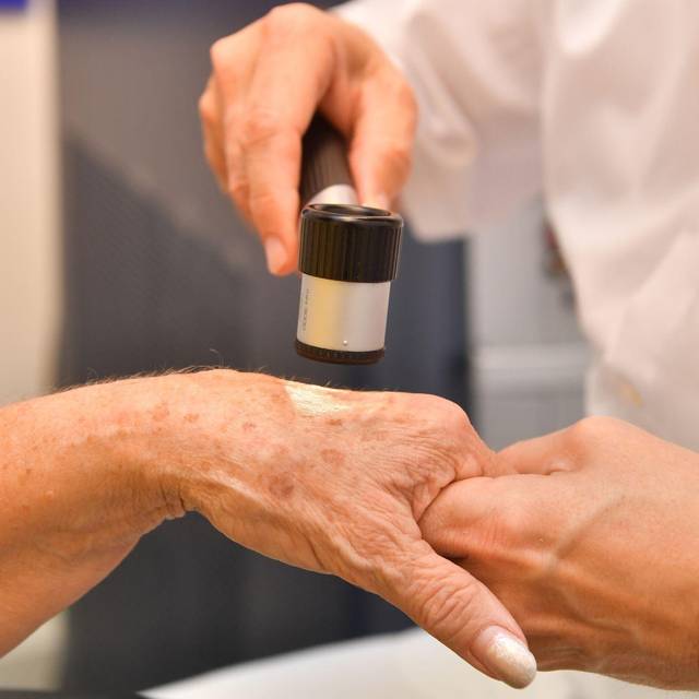Dermatologe untersucht Altersflecken auf der Hand einer Frau