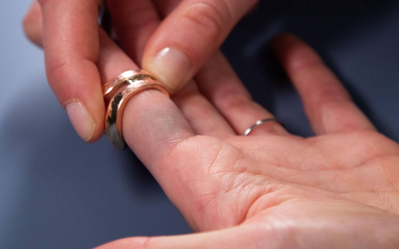 Verfärbungen durch Modeschmuck sind am Finger zu sehen