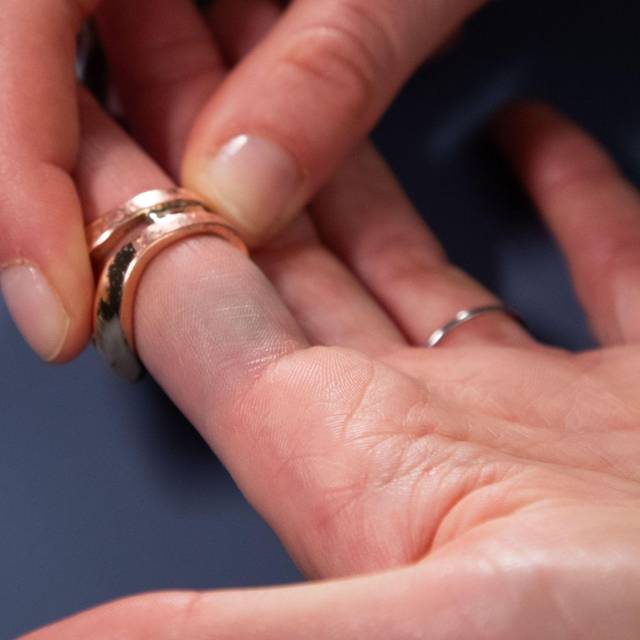 Verfärbungen durch Modeschmuck sind am Finger zu sehen