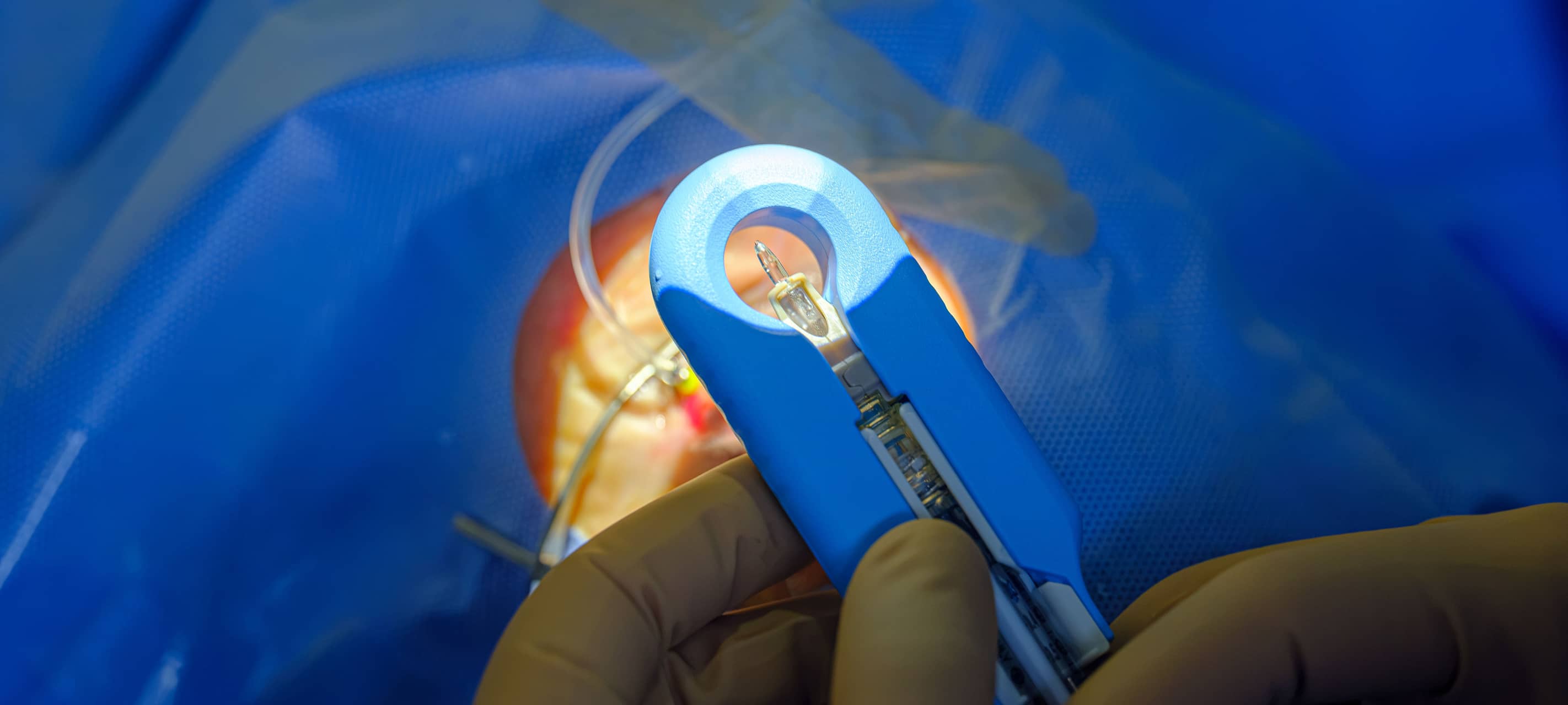 Europa-Premiere in Bonn und Linz: Neues Augenimplantat eingesetzt